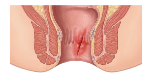 Fissura Anal
