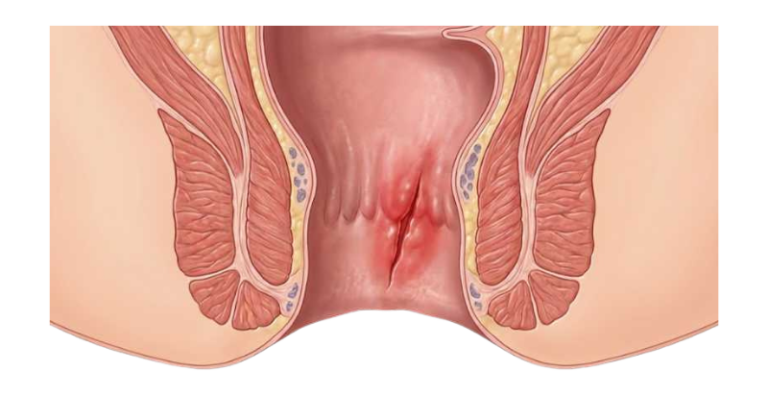 Fissura Anal