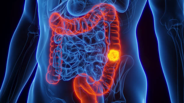 Cãncer de Intestino e Câncer Intestinal