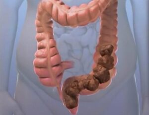 Constipação Intestinal