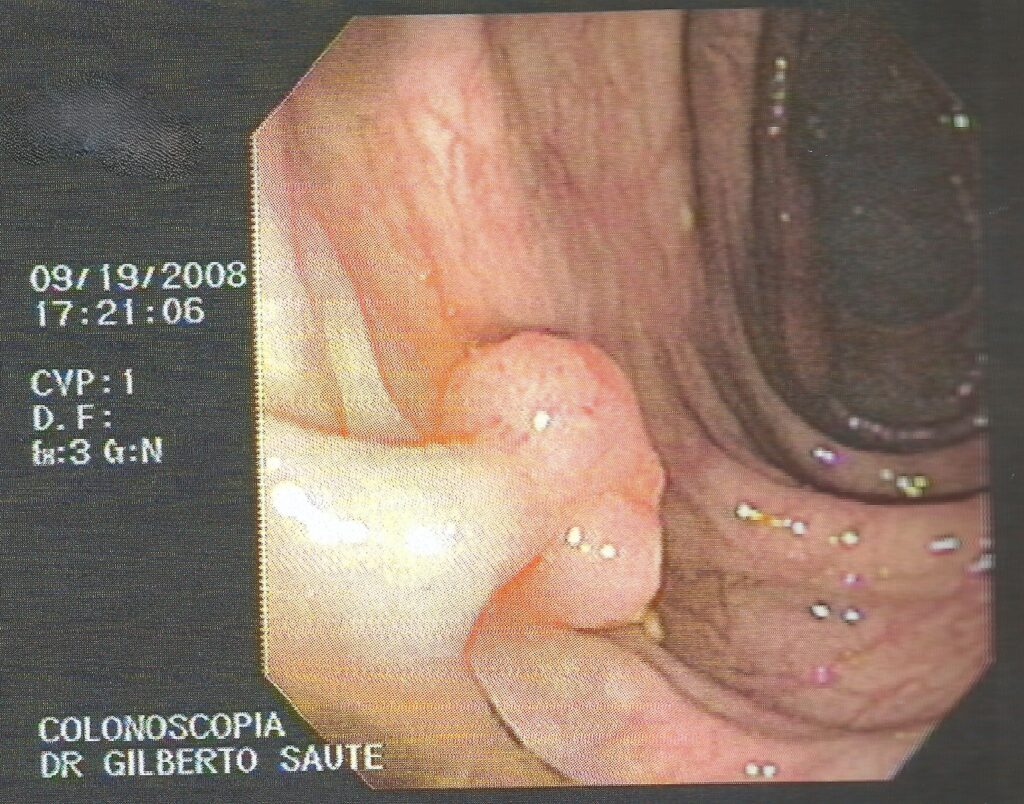 Polipo Intestinal