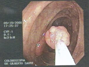 Pólipos Intestinais: Quando São Perigosos e Quando Retirar? 1 Pólipo retirado por Colonoscopia