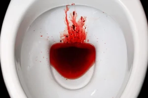 Sangue nas fezes e avaliação com proctologista