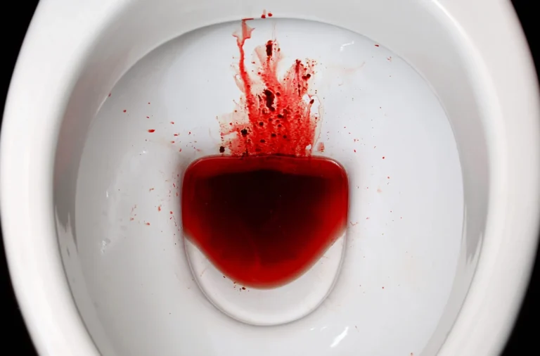 Sangue nas fezes e avaliação com proctologista